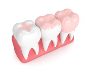 Image of three teeth with different levels of fillings on white background.
