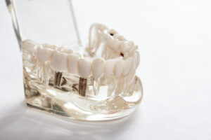 woodland hills dental implants