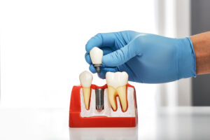 Woodland Hills dental implants